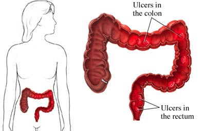 ulcers can be in the color or rectum