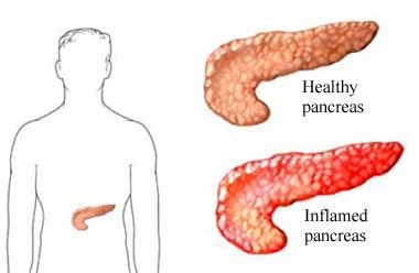 an illustration of a healthy pancreas and a red, swollen pancreas